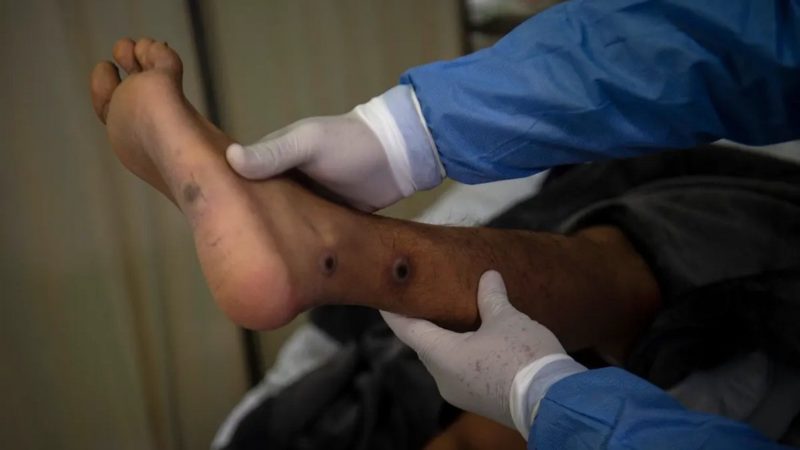 Un Dominicain d’origine haïtienne est le 10e patient testé positif à la variole du singe
